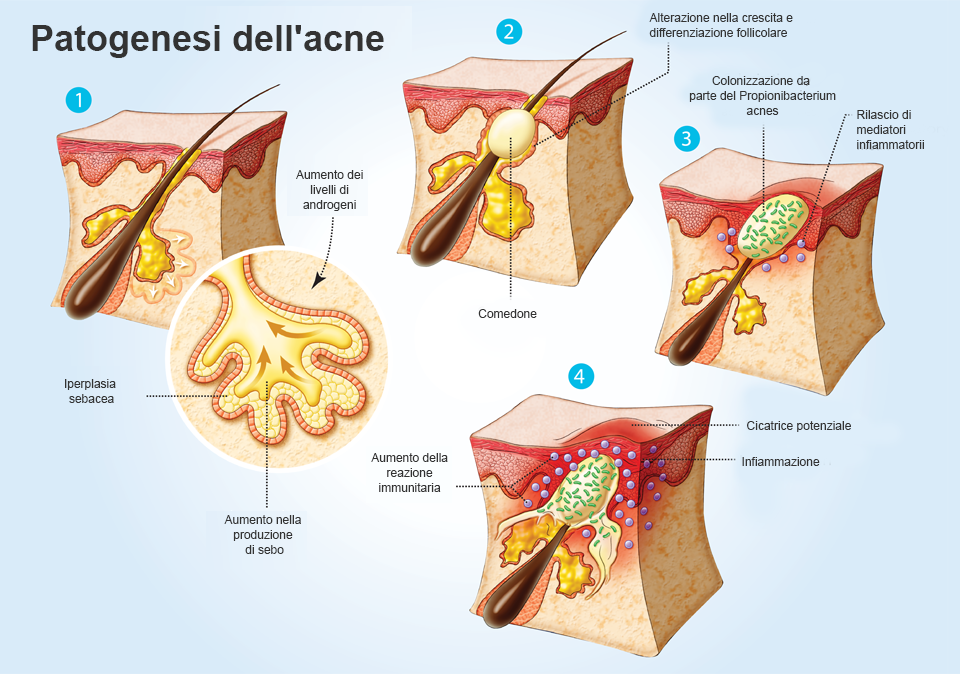 Come nasce l'acne
